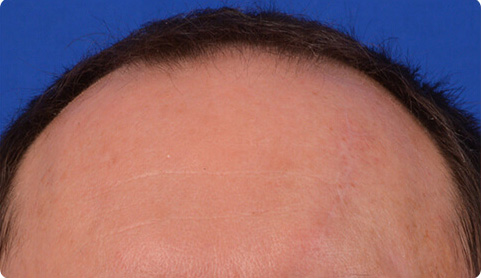 Real patient after scar reduction procedure